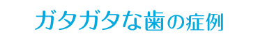 すきっ歯・ガタガタな歯の症例
