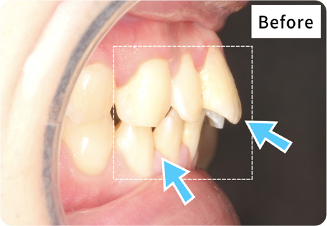キレイライン矯正の前