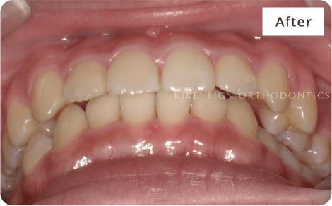 キレイライン矯正の後