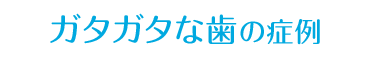 すきっ歯・ガタガタな歯の症例