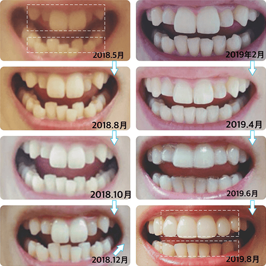 キレイライン矯正の前と後
