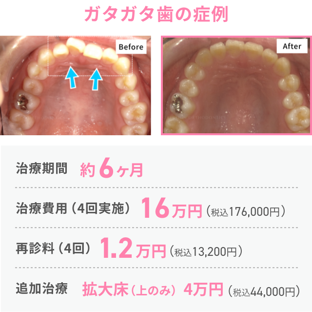 ガタガタ歯の症例