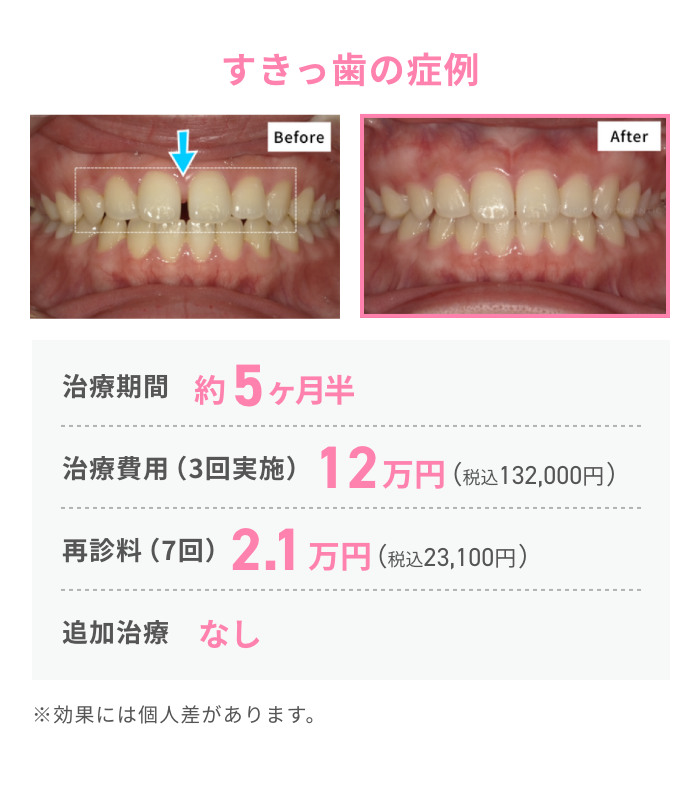 すきっ歯の症例１