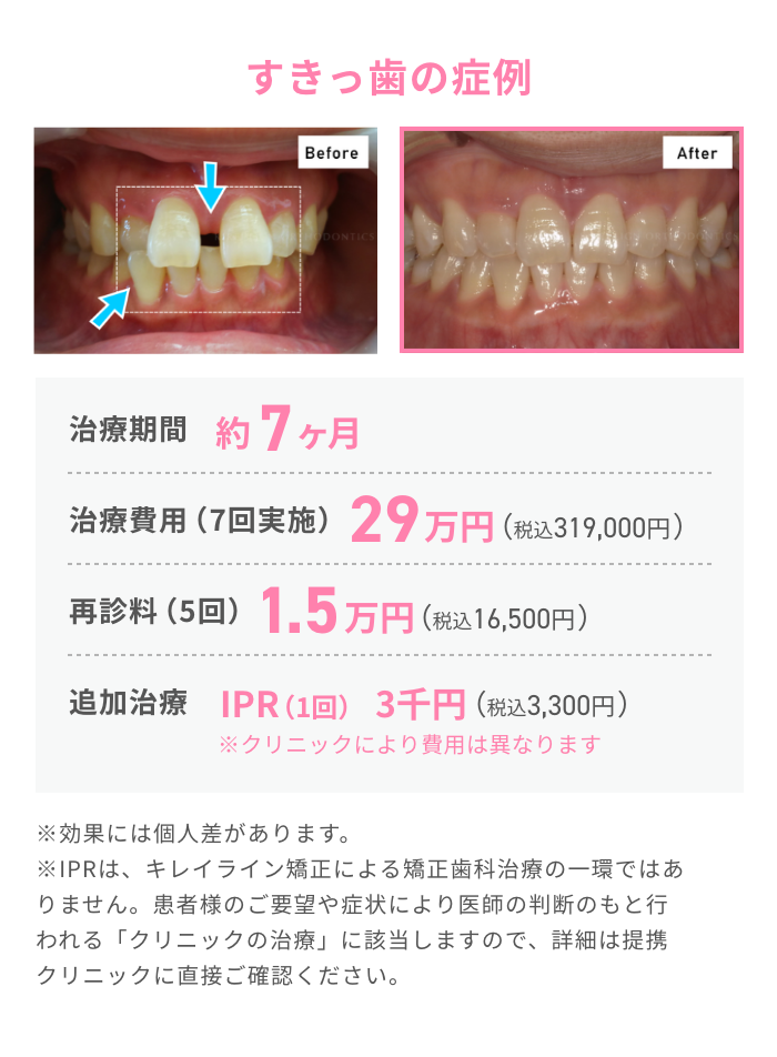 すきっ歯の症例２