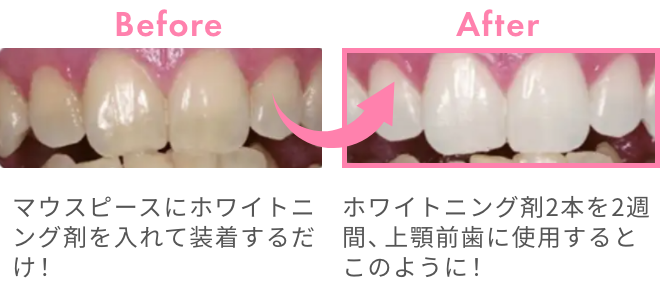 この価格でホワイトニングも同時にできます！