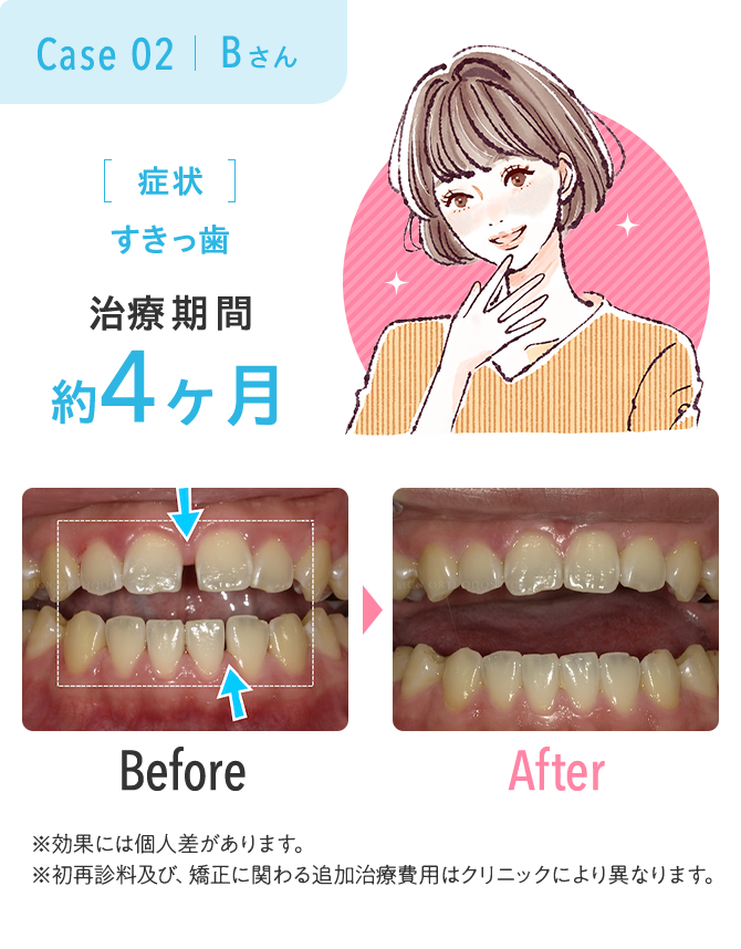 すきっ歯