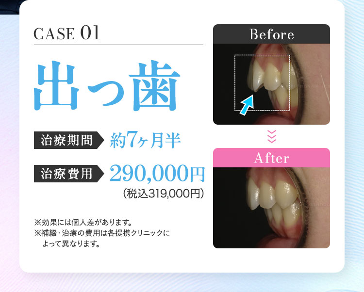 キレイラインを10回実施