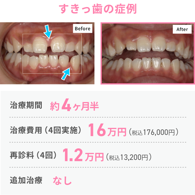 すきっ歯の症例