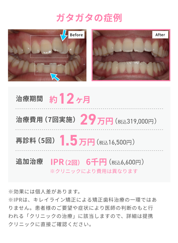 ガタガタの症例