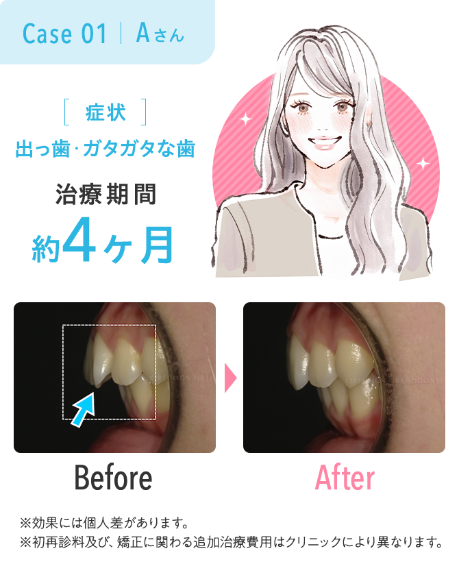 出っ歯・ガタガタな歯