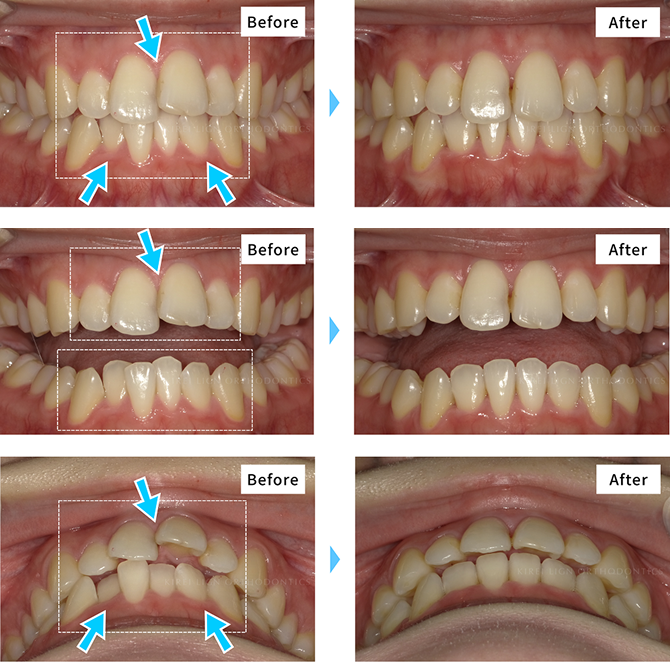 マウスピース矯正の症例写真1