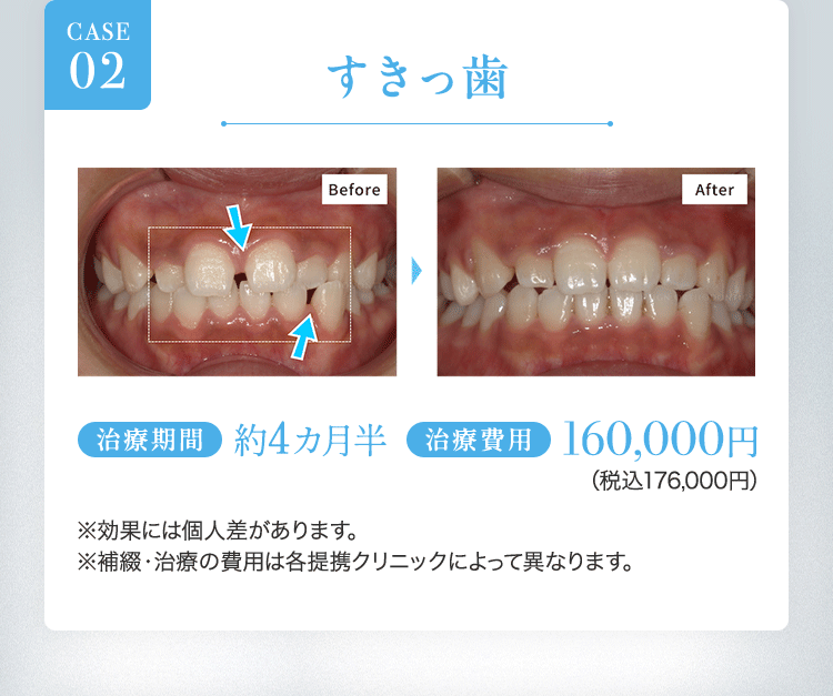 キレイラインを4回実施