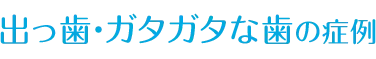 ガタガタな歯の症例