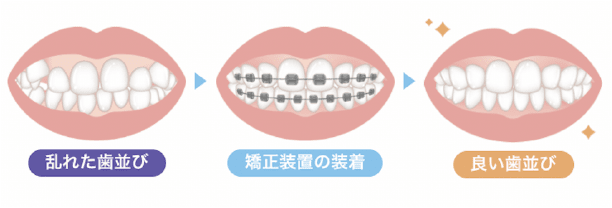 歯並びのイメージ画像