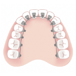 裏側矯正のイメージ画像