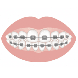 ワイヤー矯正のイメージ画像