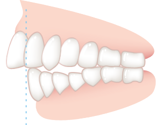 出っ歯の度合いが、軽度