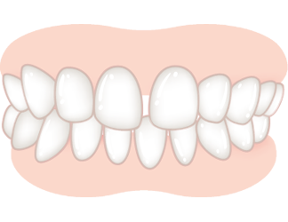 すきっ歯の度合いが、軽度