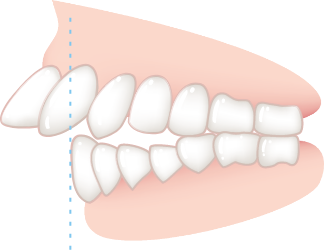 出っ歯の度合いが中度以上
