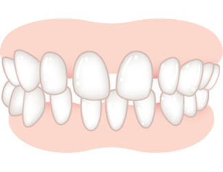 すきっ歯の度合いが中度以上