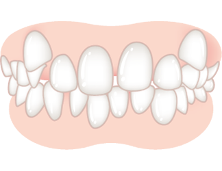ガタガタの度合いが中度以上