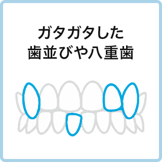 ガタガタした歯並びや八重歯