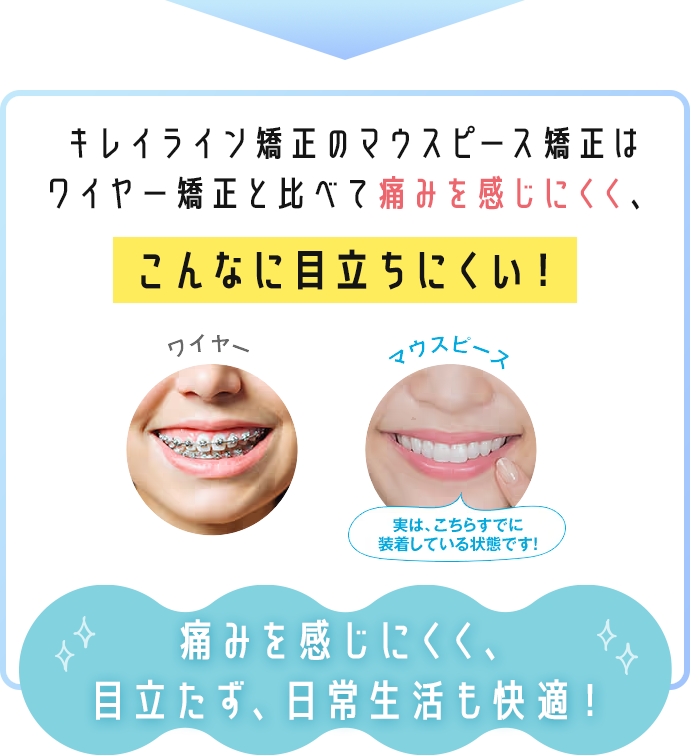 キレイライン矯正のマウスピース矯正はワイヤー矯正と比べて痛みを感じにくく、こんなに目立ちにくい！ 痛みを感じにくく、目立たず、日常生活も快適！