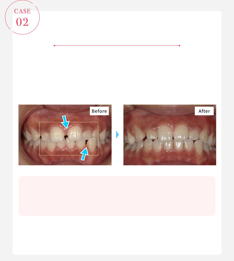 すきっ歯の女性の歯並びがキレイライン矯正で改善した症例写真（ビフォーアフター）