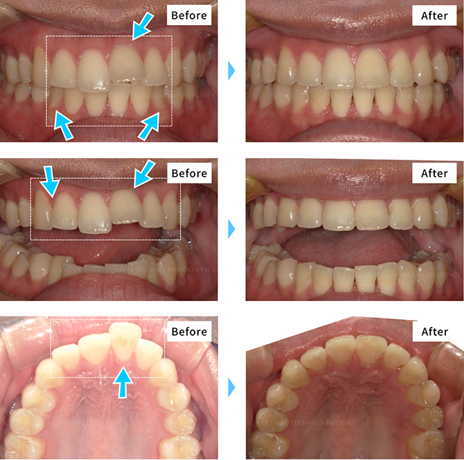 マウスピース矯正の症例写真3