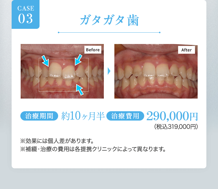 キレイラインを10回実施