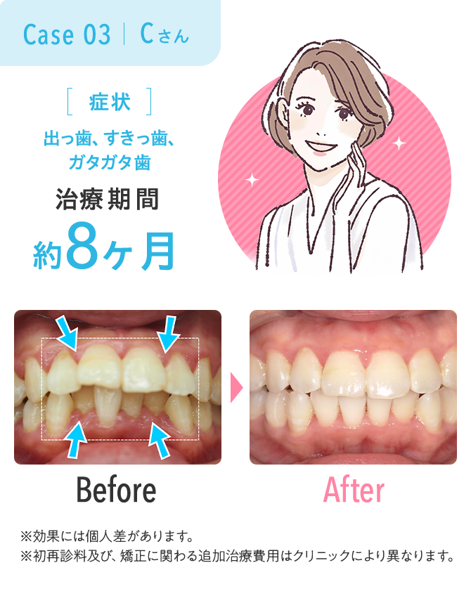 出っ歯、すきっ歯、 ガタガタ歯