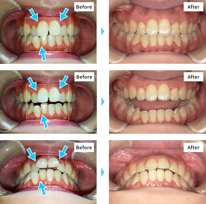 マウスピース矯正の症例写真2