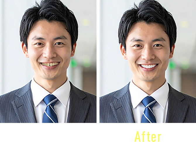 年齢を重ねるほど 歯は動きにくく なります