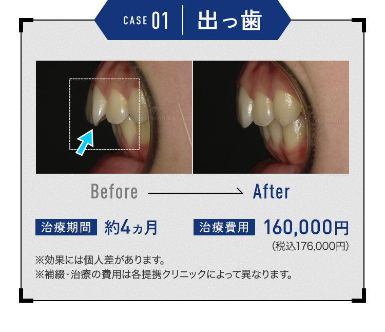 キレイラインを4回実施