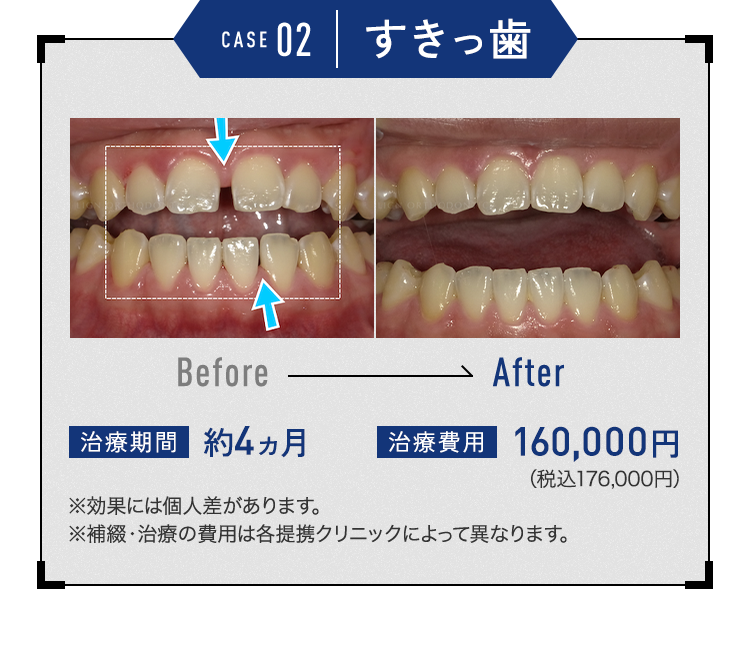 キレイラインを10回実施