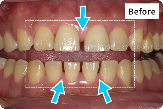キレイライン矯正の前