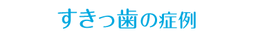 すきっ歯の症例