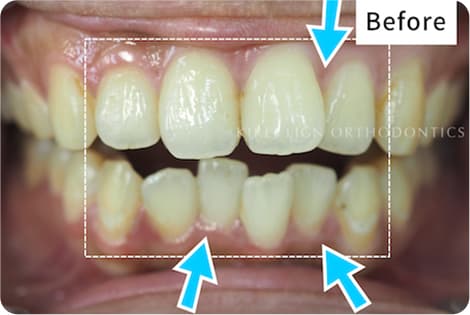 キレイライン矯正の前