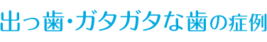 ガタガタな歯の症例