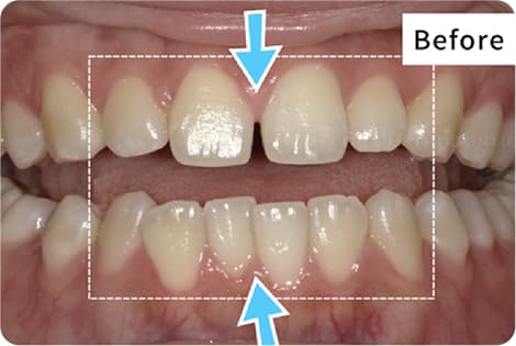 キレイライン矯正の前