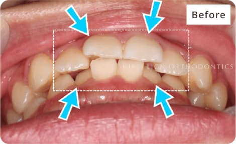 キレイライン矯正の前