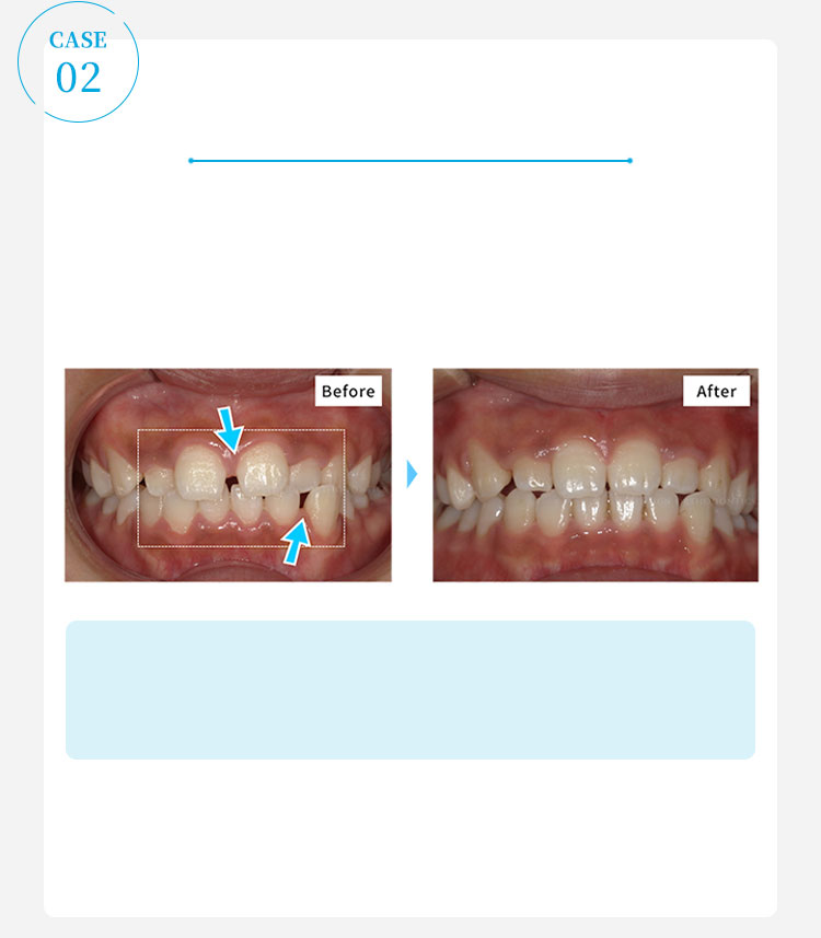 キレイラインを4回実施