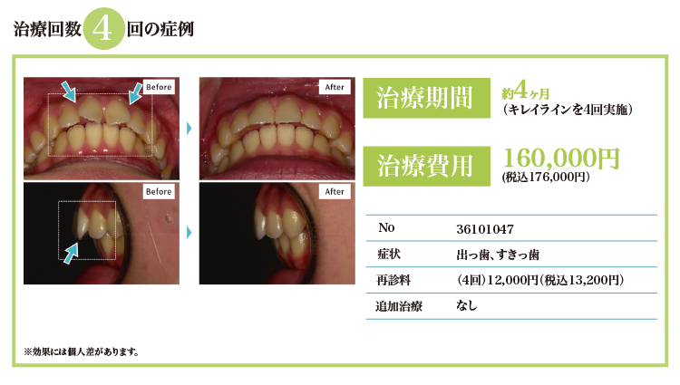 治療回数4回、税抜¥160,000。出っ歯、すきっ歯の症状