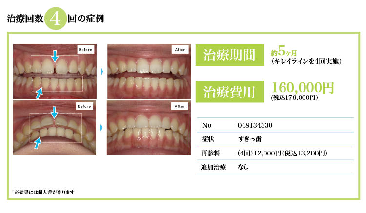 治療回数4回、税抜¥160,000。すきっ歯の症状