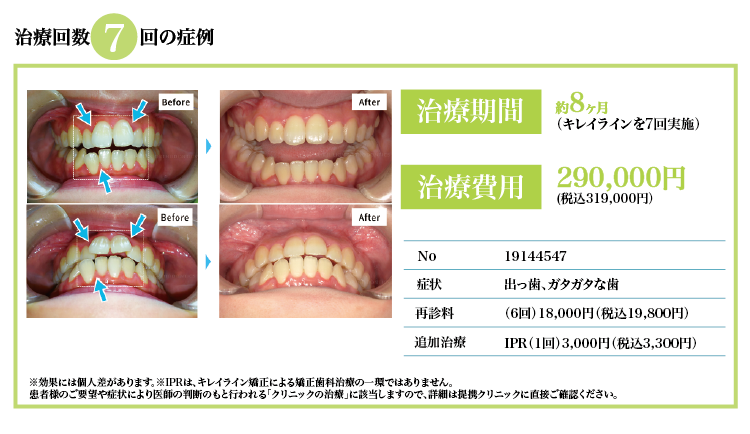 治療回数7回、税抜¥290,000。出っ歯、ガタガタな歯の症状