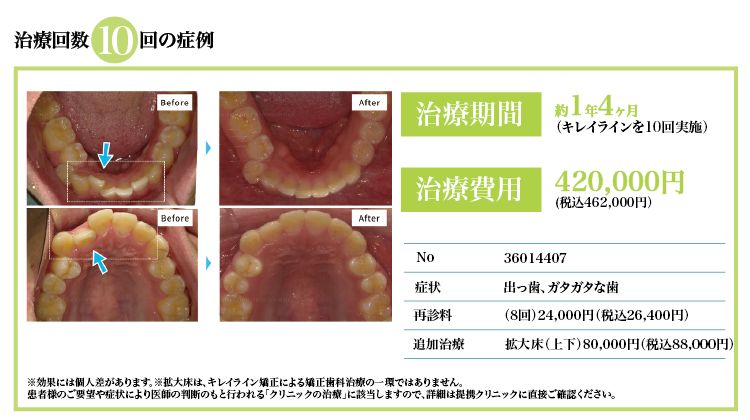 治療回数10回、税抜¥420,000。出っ歯、ガタガタな歯の症状