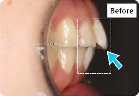 キレイライン矯正の前