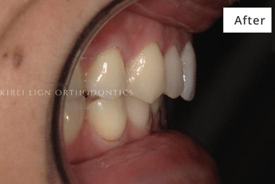 キレイライン矯正の後