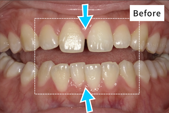 キレイライン矯正の前