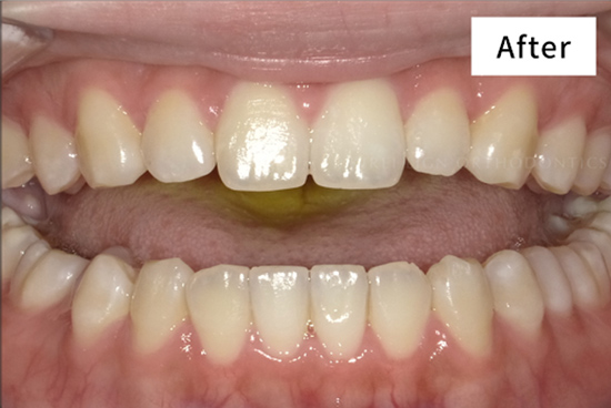 キレイライン矯正の後